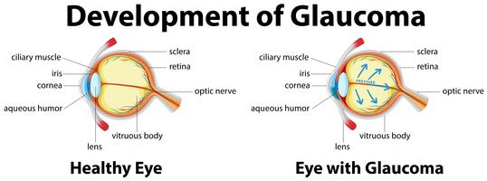 Sviluppo del glaucoma negli occhi umani vettore