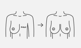 mastectomia Seno cancro e Seno ricostruzione. mammario cancro, mastectomia. vettore illustrazione
