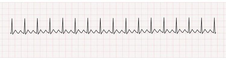 ekg tenere sotto controllo mostrando atriale svolazzare con 2 per 1 av bloccare vettore