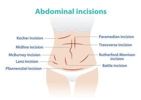 tipi di addominale incisione per chirurgia vettore illustrazione isolato su bianca sfondo. kocher, linea mediana, McBurney, lanz, Pfannenstiel, paramediano, trasversale, rutherford morrisone, battaglia incisione.