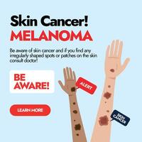 melanoma pelle cancro. pelle cancro consapevolezza inviare con Due diverso etnico mani avendo melanoma cancro macchie. consapevolezza sociale media inviare per pelle cancro pazienti. melanoma avvertimento segni. vettore