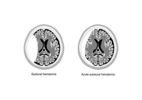 comparativo medico illustrazione di epidurale e acuto subdurale ematoma nel il umano cervello. vettore