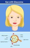 Diagramma che mostra l&#39;occhio con il glaucoma vettore