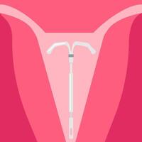 il metodo di contraccezione è un intrauterino spirale. illustrazione vettore