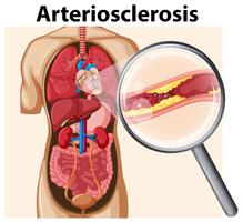 Corpo umano con arteriosclerosi vettore