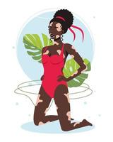 malattia della pelle vitiligine in ragazza afroamericana in costume da bagno. la donna con una diagnosi di vitiligine che prende il sole sulla spiaggia non è timida. il concetto di bellezza diversa, positiva corporea, accettazione di sé. vettore