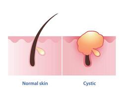 cistica acne, il maggior parte acuto genere di infiammatorio acne vettore su bianca sfondo. normale pelle e cisti sviluppare pus pieno foruncolo in profondità sotto il pelle, spesso doloroso, grande e per causa cicatrici.