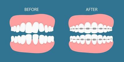 illustrazione vettoriale delle fasi del trattamento ortodontico bretelle sui denti. denti prima, dopo l'apparecchio. sfondo in style.vector piatto su sfondo blu. concetto dentale.
