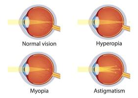 disturbi della vista. concetto di difetto agli occhi. visione normale, ipermetropia, miopia, astigmatismo. bulbo oculare di anatomia. vettore