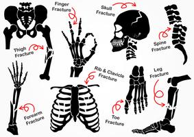 Impostare l&#39;icona della frattura ossea (pelvica, anca, coscia (femore), mano, polso, dito, cranio, viso, vertebra, braccio, gomito, torace, piede, tallone, gamba) disegno in bianco e nero (concetto di assistenza sanitaria) vettore