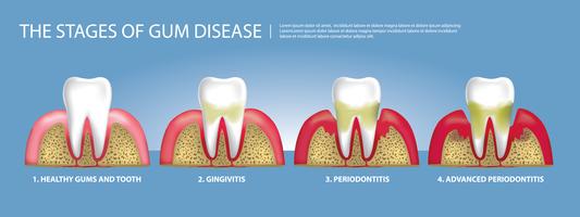 Fasi dei denti umani dell&#39;illustrazione di vettore della malattia di gomma