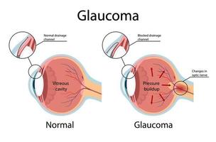 glaucoma. illustrazione che mostra il glaucoma ad angolo aperto. anatomia dell'occhio in stile cartone animato vettore