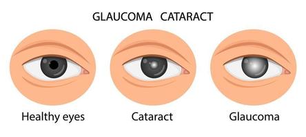 illustrazione di un occhio sano, glaucoma, cataratta. vettore