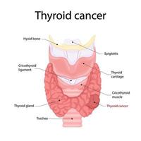 anatomia del cancro della tiroide. icona di anatomia degli organi del corpo umano. concetto medico. vettore