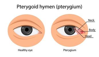 lo pterigio cresce sulla cornea. malattia degli occhi. illustrazione vettoriale dei cartoni animati.