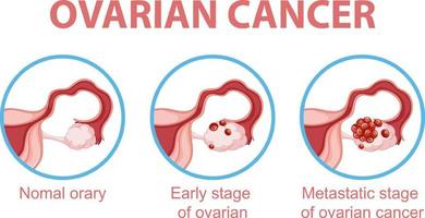 infografica sul processo di sviluppo del cancro ovarico vettore