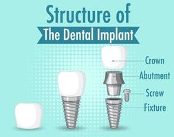 infografica dell'essere umano nella struttura dell'impianto dentale vettore