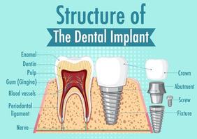 infografica dell'essere umano nella struttura dell'impianto dentale vettore