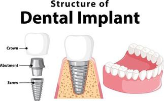 infografica dell'essere umano nella struttura dell'impianto dentale vettore