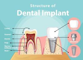 infografica dell'essere umano nella struttura dell'impianto dentale vettore