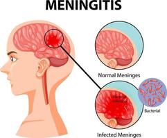 diagramma che mostra la meningite nel cervello umano vettore