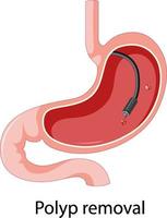 diagramma che mostra la rimozione del polipo nell'uomo vettore