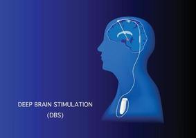 stimolazione cerebrale profonda per il trattamento della malattia di Parkinson vettore