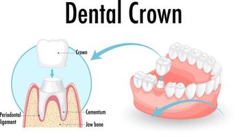 infografica dell'essere umano nella corona dentale