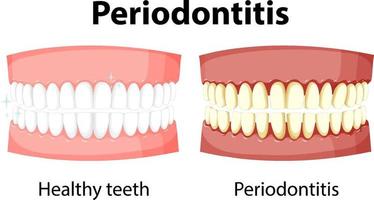 infografica dell'essere umano nella parodontite vettore