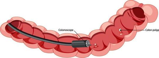 diagramma che mostra l'interno del colon con il colonscopio vettore