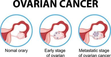 diagramma che mostra il cancro dell'ovarina nell'uomo vettore