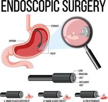 diagramma che mostra la chirurgia endoscopica vettore