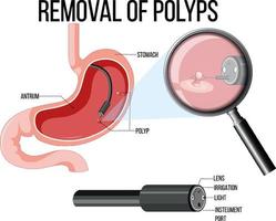 diagramma che mostra la rimozione dei polipi vettore