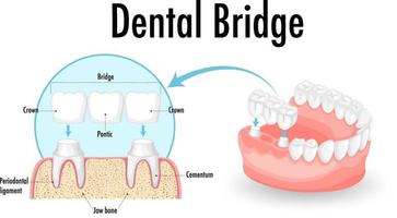 infografica dell'essere umano nel ponte dentale su sfondo bianco vettore