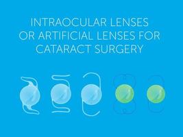 lenti intraoculari o lenti artificiali per la chirurgia della cataratta vettore