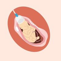 processo di sottovuoto del bambino alla nascita per contenuto medico e obgyn vettore