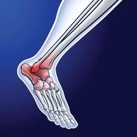 un'illustrazione di un osso della caviglia in esecuzione che mostra punti rossi che rappresentano una lesione articolare. vettore