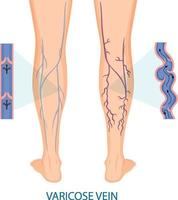 gambe umane con vene varicose vettore