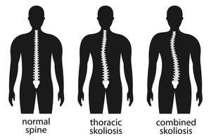 illustrazione vettoriale di deformità spinale. infografica della colonna vertebrale cifosi, lordosi e scoliosi. difetto di postura del corpo. striscioni medici, educativi e scientifici.