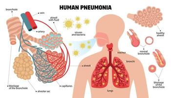 set di infografica polmonite umana vettore