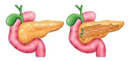 insieme realistico dell'icona del pancreas vettore