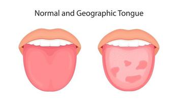 malattia della lingua, vettore del concetto di organi.