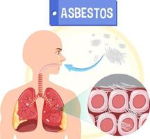 diagramma che mostra l'asbestosi nei polmoni vettore