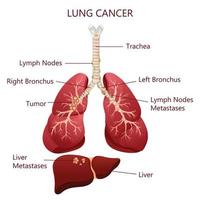 diagramma malattia del cancro del polmone. concetto di malattia degli organi interni umani. illustrazione vettoriale, stile cartone animato. vettore