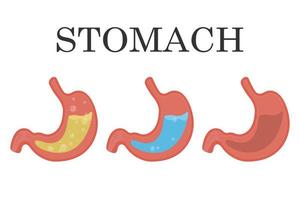 stomaco umano sano e malsano, vuoto e pieno, reflusso del succo gastrico. nutrizione, mal di stomaco, gonfiore. anatomia dell'apparato digerente. set di illustrazioni vettoriali mediche dello stomaco.