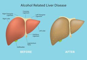 Informazioni vettoriali sulla malattia epatica correlata all'alcol